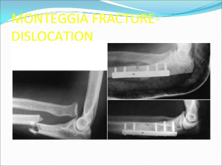 MONTEGGIA FRACTUREDISLOCATION 