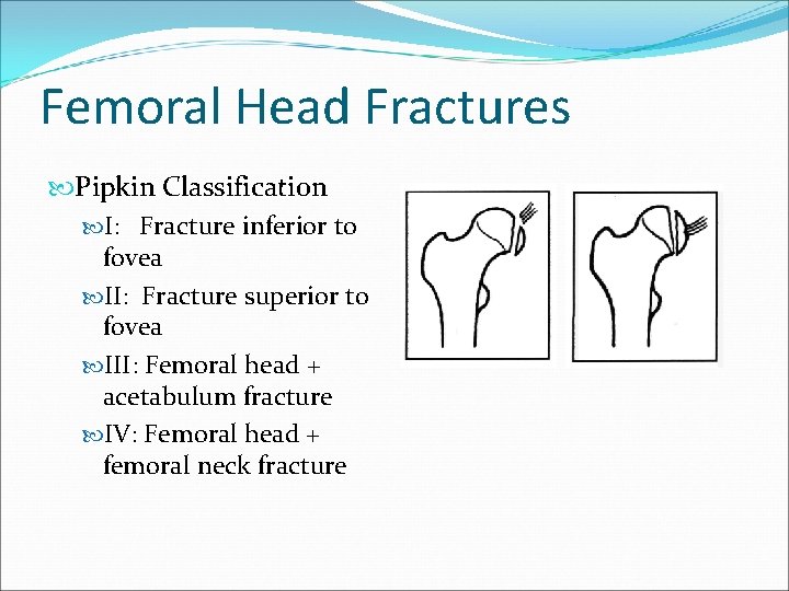 Femoral Head Fractures Pipkin Classification I: Fracture inferior to fovea II: Fracture superior to