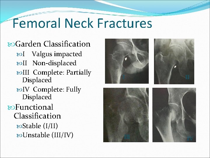 Femoral Neck Fractures Garden Classification I Valgus impacted II Non-displaced III Complete: Partially Displaced