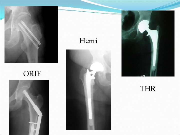 Hemi ORIF THR 