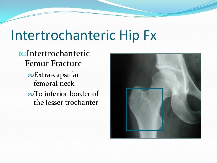 Intertrochanteric Hip Fx Intertrochanteric Femur Fracture Extra-capsular femoral neck To inferior border of the