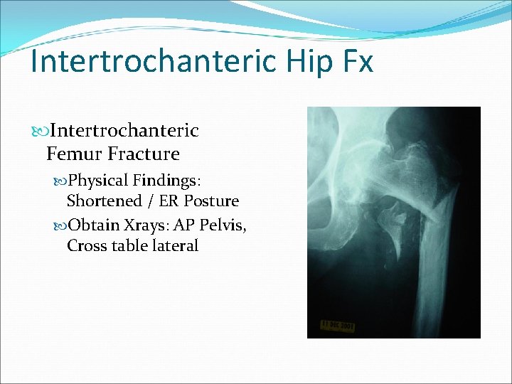 Intertrochanteric Hip Fx Intertrochanteric Femur Fracture Physical Findings: Shortened / ER Posture Obtain Xrays: