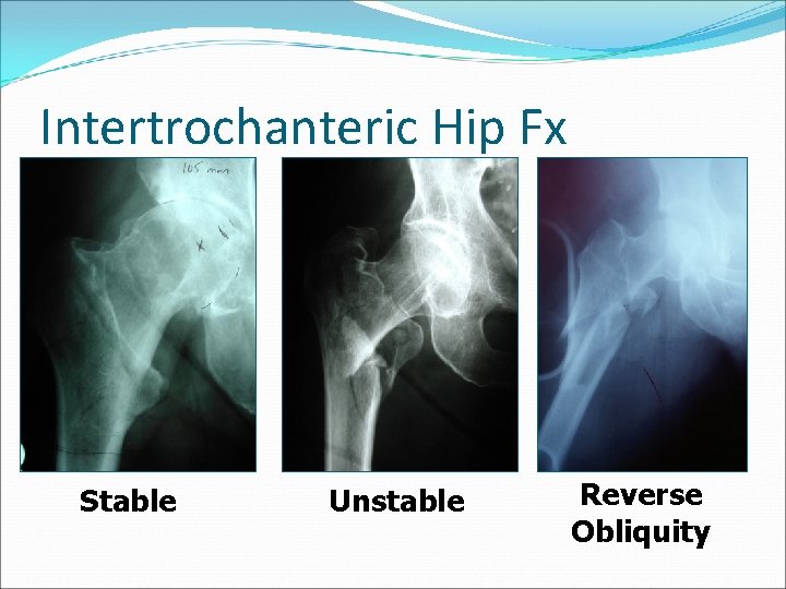 Intertrochanteric Hip Fx Stable Unstable Reverse Obliquity 
