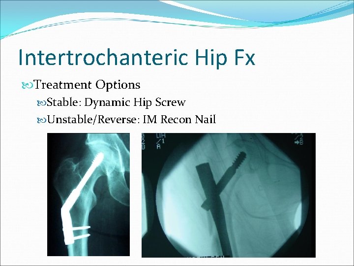 Intertrochanteric Hip Fx Treatment Options Stable: Dynamic Hip Screw Unstable/Reverse: IM Recon Nail 