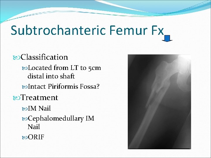 Subtrochanteric Femur Fx Classification Located from LT to 5 cm distal into shaft Intact