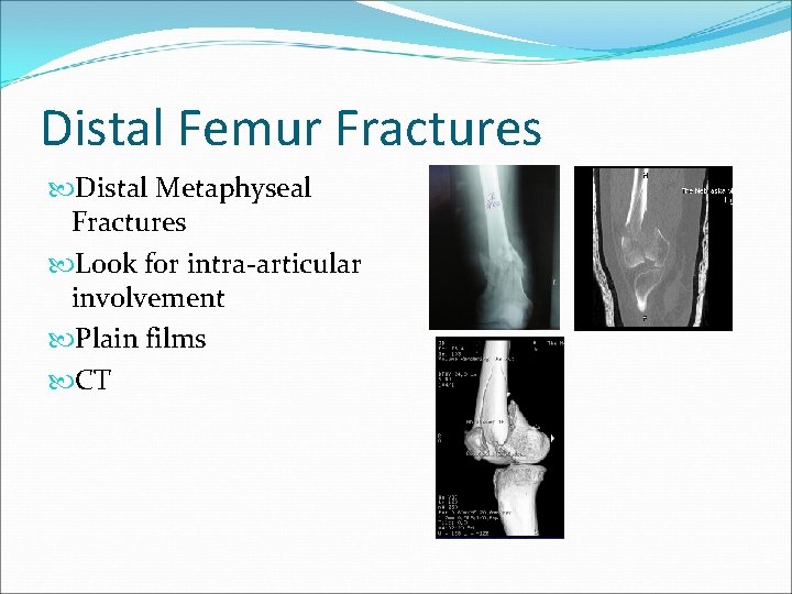 Distal Femur Fractures Distal Metaphyseal Fractures Look for intra-articular involvement Plain films CT 