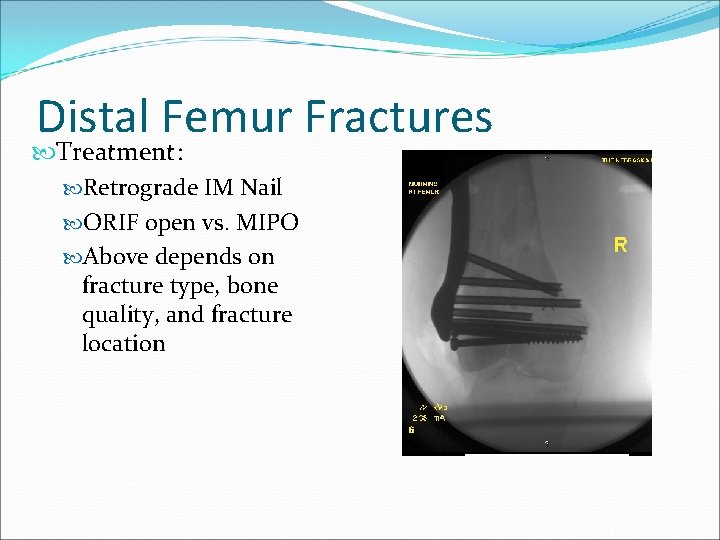 Distal Femur Fractures Treatment: Retrograde IM Nail ORIF open vs. MIPO Above depends on