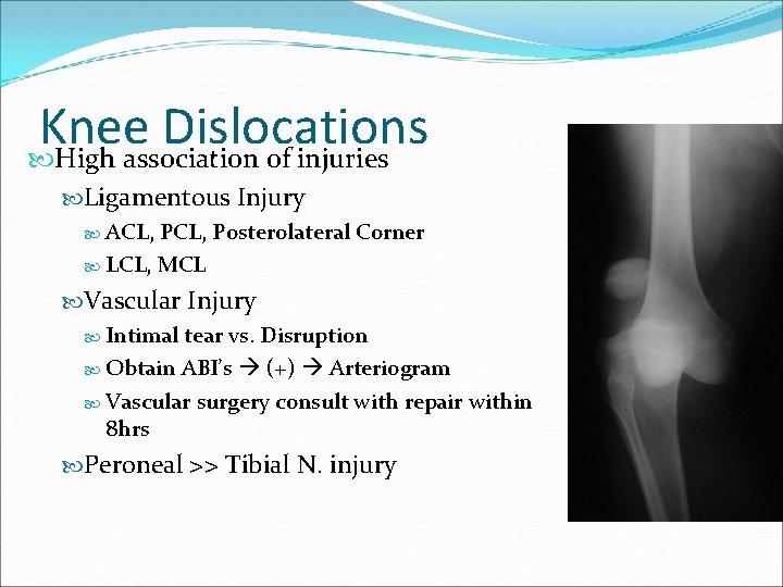 Knee Dislocations High association of injuries Ligamentous Injury ACL, Posterolateral Corner LCL, MCL Vascular