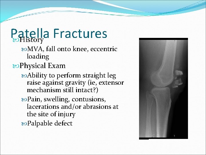 Patella Fractures History MVA, fall onto knee, eccentric loading Physical Exam Ability to perform