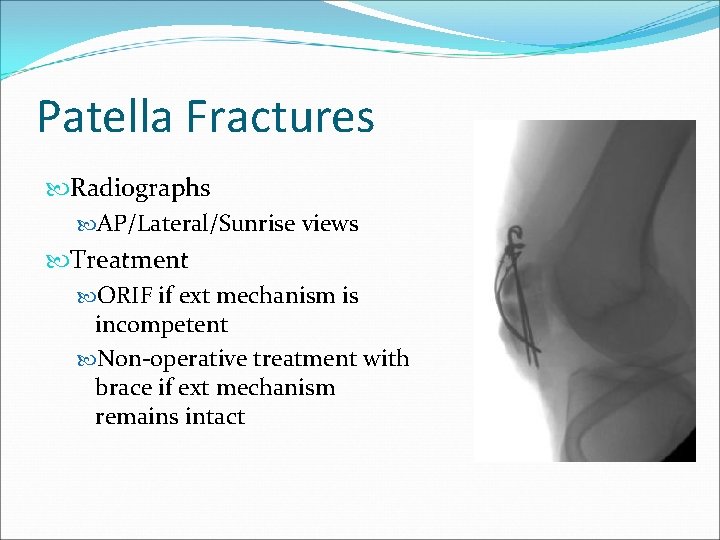 Patella Fractures Radiographs AP/Lateral/Sunrise views Treatment ORIF if ext mechanism is incompetent Non-operative treatment