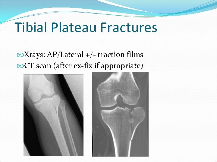 Tibial Plateau Fractures Xrays: AP/Lateral +/- traction films CT scan (after ex-fix if appropriate)