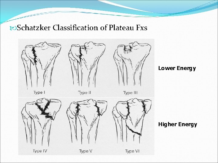  Schatzker Classification of Plateau Fxs Lower Energy Higher Energy 