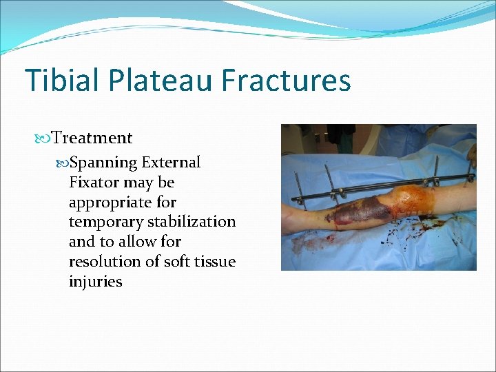 Tibial Plateau Fractures Treatment Spanning External Fixator may be appropriate for temporary stabilization and