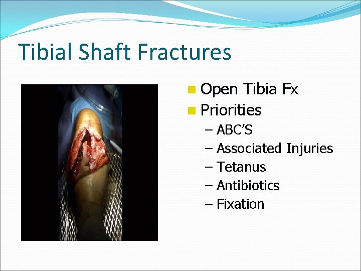 Tibial Shaft Fractures n Open Tibia Fx n Priorities – ABC’S – Associated Injuries