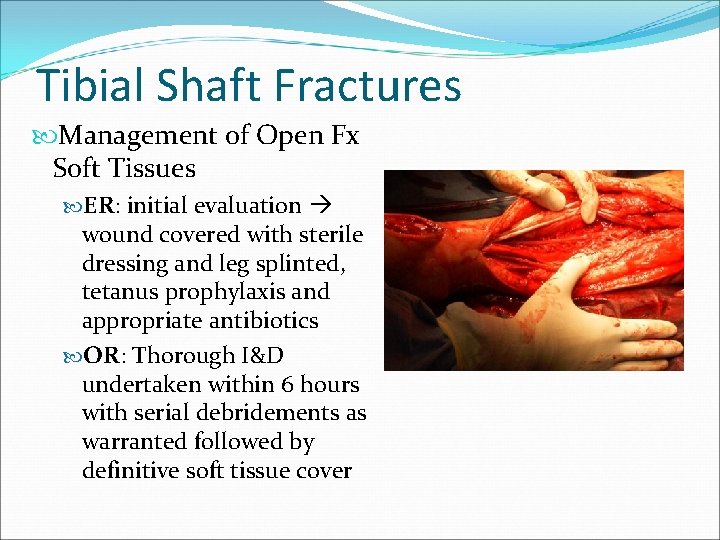 Tibial Shaft Fractures Management of Open Fx Soft Tissues ER: initial evaluation wound covered