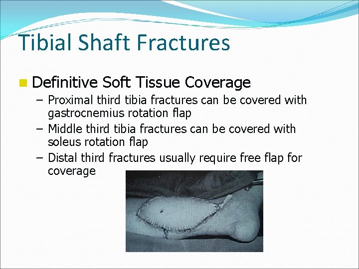 Tibial Shaft Fractures n Definitive Soft Tissue Coverage – Proximal third tibia fractures can