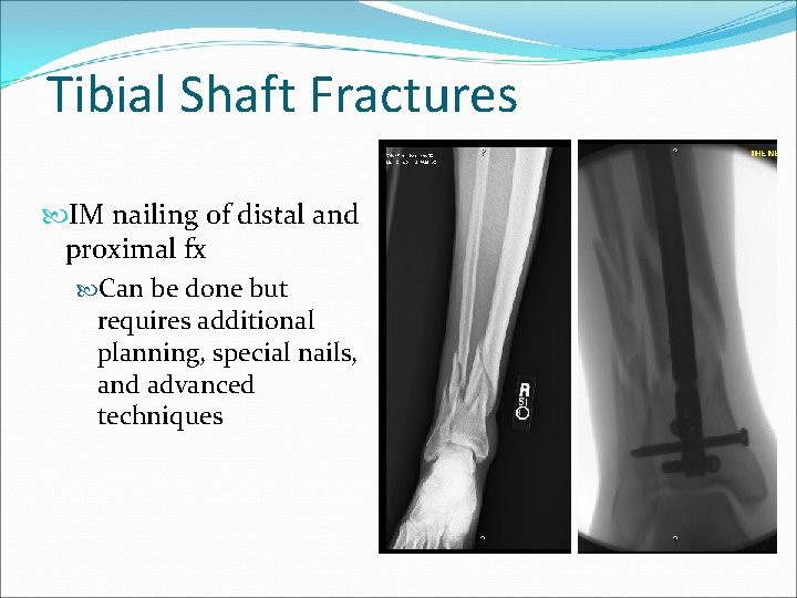 Tibial Shaft Fractures IM nailing of distal and proximal fx Can be done but