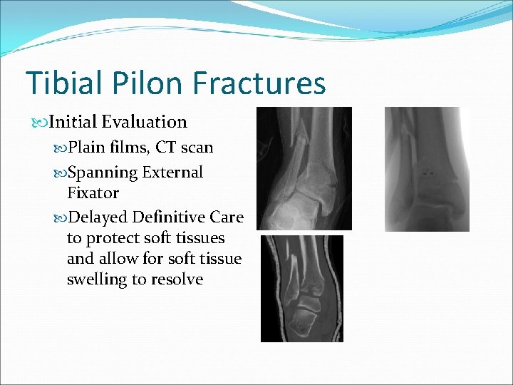 Tibial Pilon Fractures Initial Evaluation Plain films, CT scan Spanning External Fixator Delayed Definitive