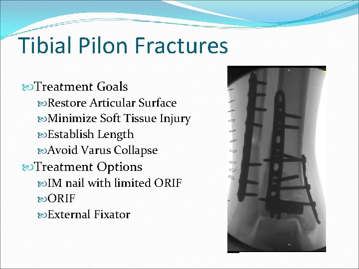 Tibial Pilon Fractures Treatment Goals Restore Articular Surface Minimize Soft Tissue Injury Establish Length