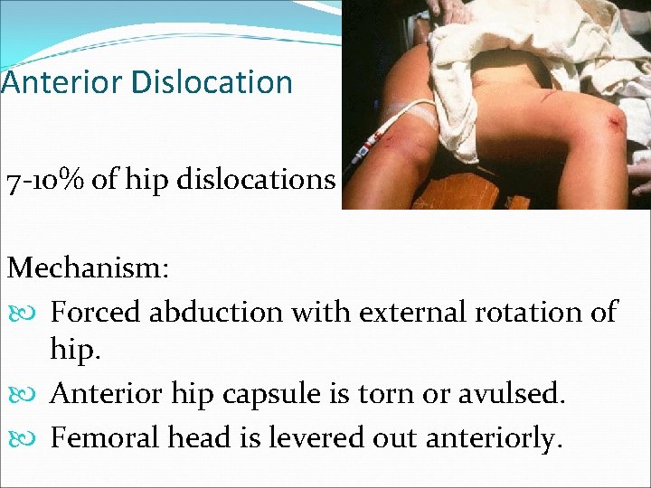 Anterior Dislocation 7 -10% of hip dislocations Mechanism: Forced abduction with external rotation of