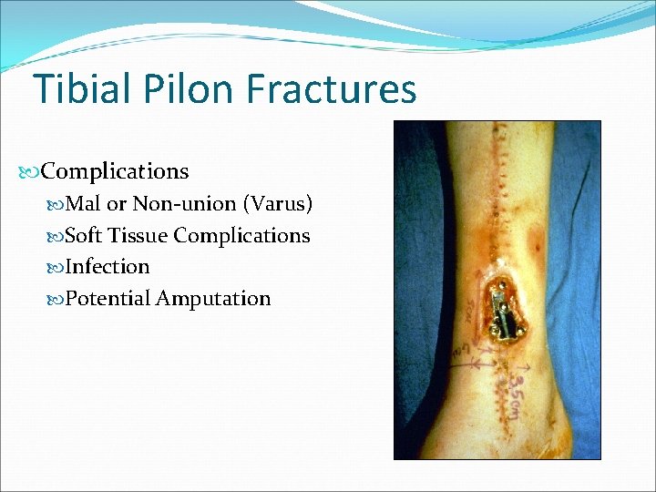 Tibial Pilon Fractures Complications Mal or Non-union (Varus) Soft Tissue Complications Infection Potential Amputation