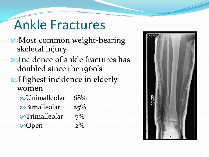 Ankle Fractures Most common weight-bearing skeletal injury Incidence of ankle fractures has doubled since