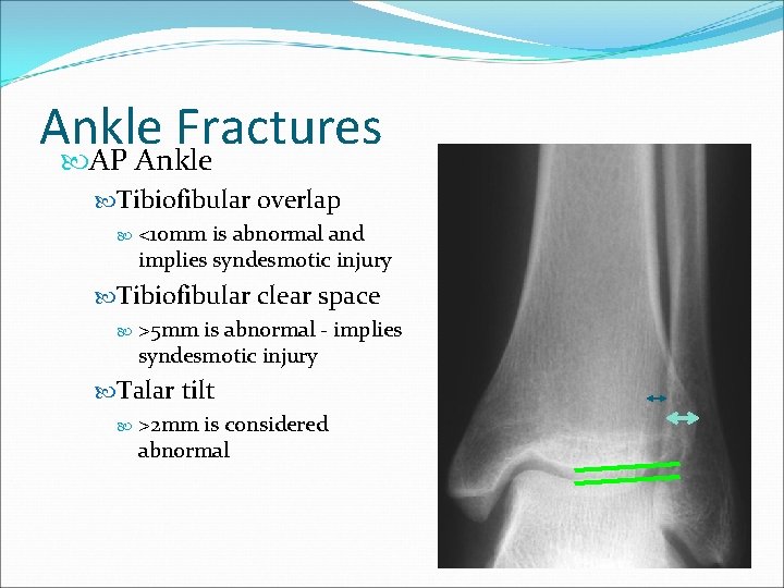 Ankle Fractures AP Ankle Tibiofibular overlap <10 mm is abnormal and implies syndesmotic injury