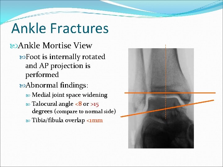 Ankle Fractures Ankle Mortise View Foot is internally rotated and AP projection is performed