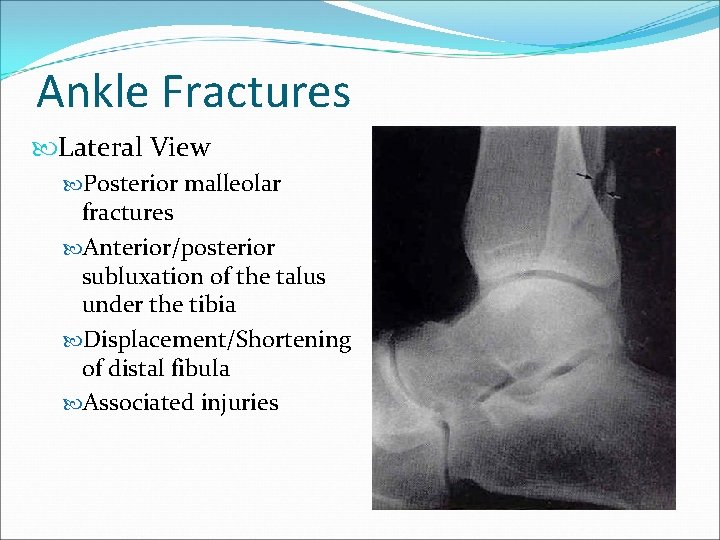 Ankle Fractures Lateral View Posterior malleolar fractures Anterior/posterior subluxation of the talus under the