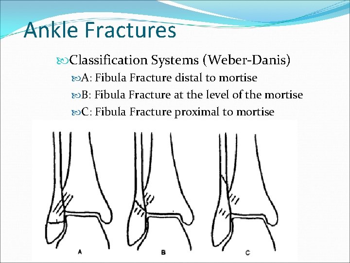 Ankle Fractures Classification Systems (Weber-Danis) A: Fibula Fracture distal to mortise B: Fibula Fracture