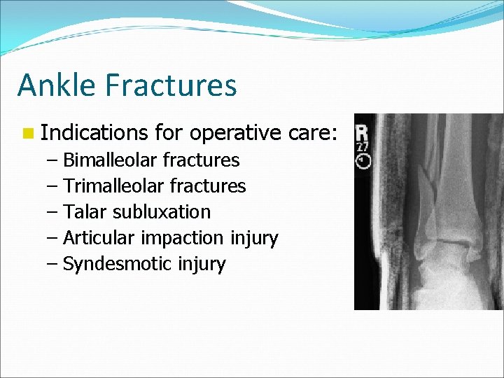Ankle Fractures n Indications for operative care: – Bimalleolar fractures – Trimalleolar fractures –