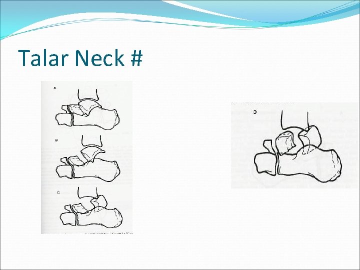 Talar Neck # 