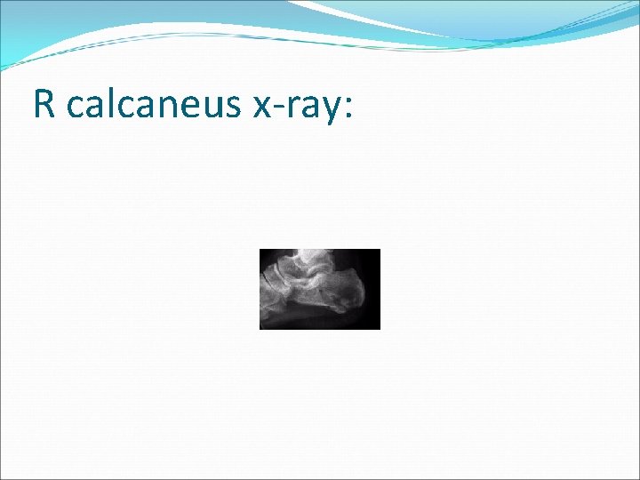 R calcaneus x-ray: 