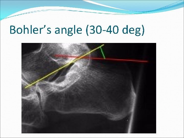 Bohler’s angle (30 -40 deg) 