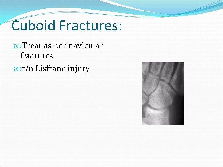 Cuboid Fractures: Treat as per navicular fractures r/o Lisfranc injury 