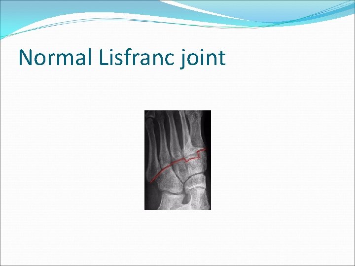 Normal Lisfranc joint 