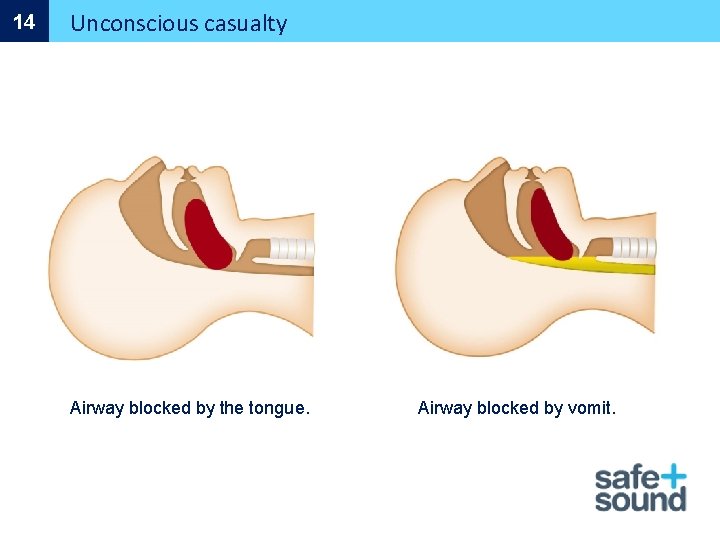 14 Unconscious casualty Airway blocked by the tongue. Airway blocked by vomit. 