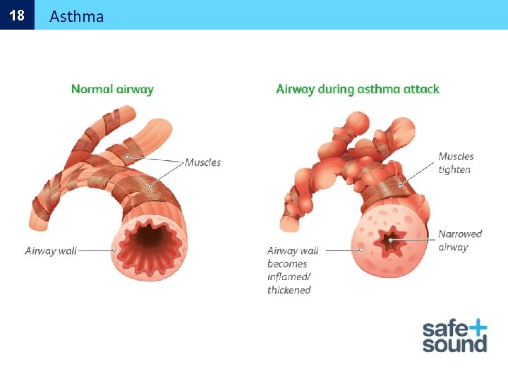 18 Asthma 