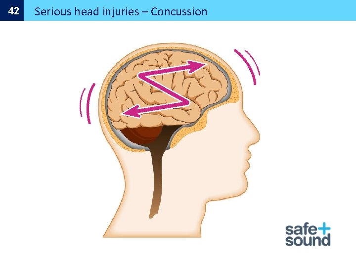 42 Serious head injuries – Concussion 