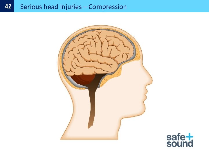 42 Serious head injuries – Compression 