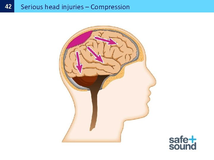 42 Serious head injuries – Compression 
