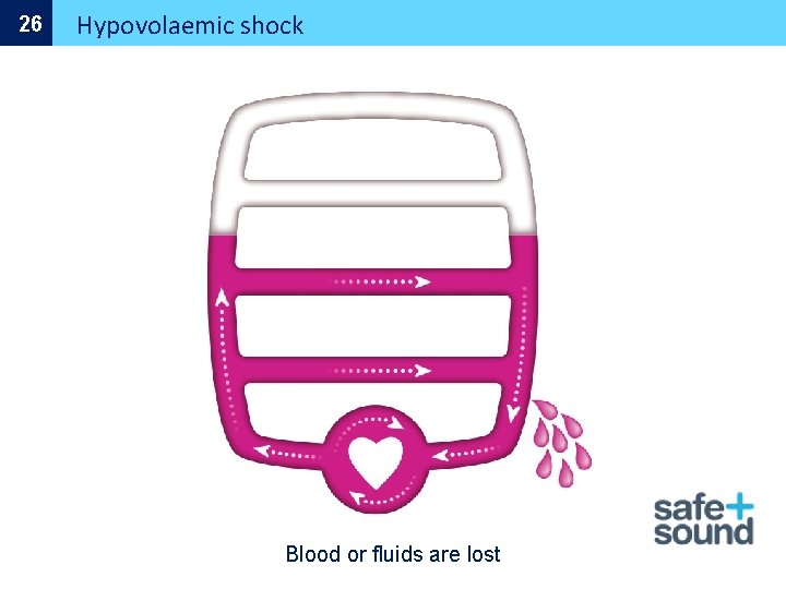 26 Hypovolaemic shock Blood or fluids are lost 