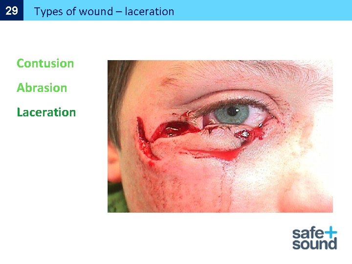 29 Types of wound – laceration Contusion Abrasion Laceration 