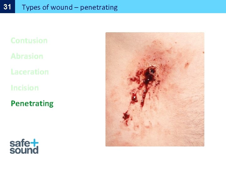 31 Types of wound – penetrating Contusion Abrasion Laceration Incision Penetrating 