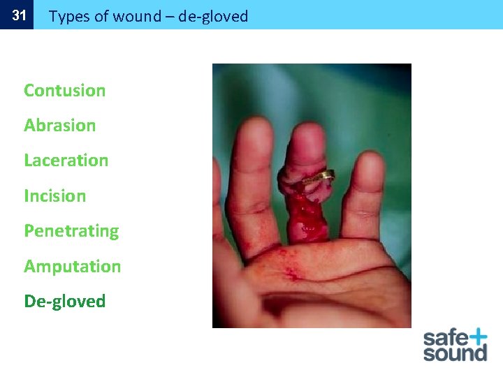 31 Types of wound – de-gloved Contusion Abrasion Laceration Incision Penetrating Amputation De-gloved 