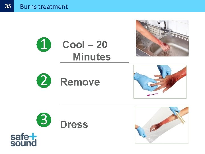 35 Burns treatment 1 Cool – 20 Minutes 2 Remove 3 Dress 