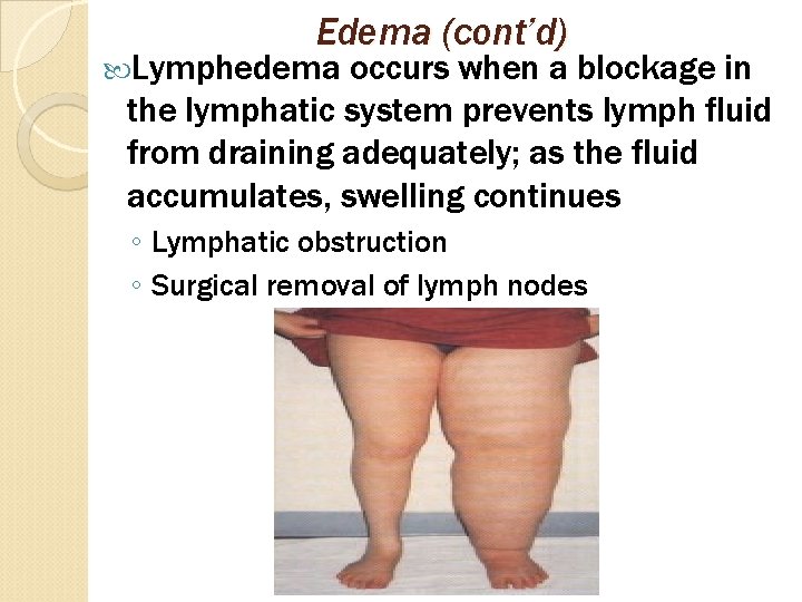 Edema (cont’d) Lymphedema occurs when a blockage in the lymphatic system prevents lymph fluid