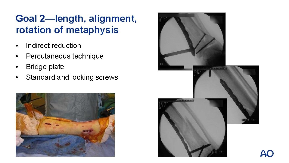 Goal 2—length, alignment, rotation of metaphysis • • Indirect reduction Percutaneous technique Bridge plate