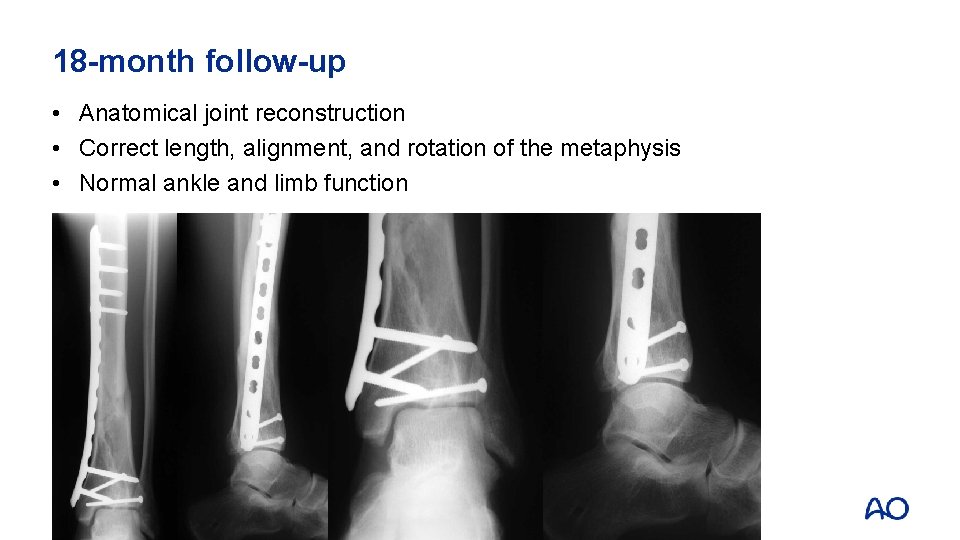 18 -month follow-up • Anatomical joint reconstruction • Correct length, alignment, and rotation of