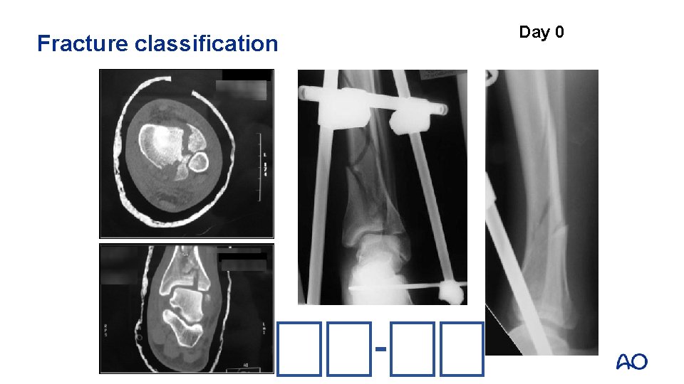 Fracture classification Day 0 